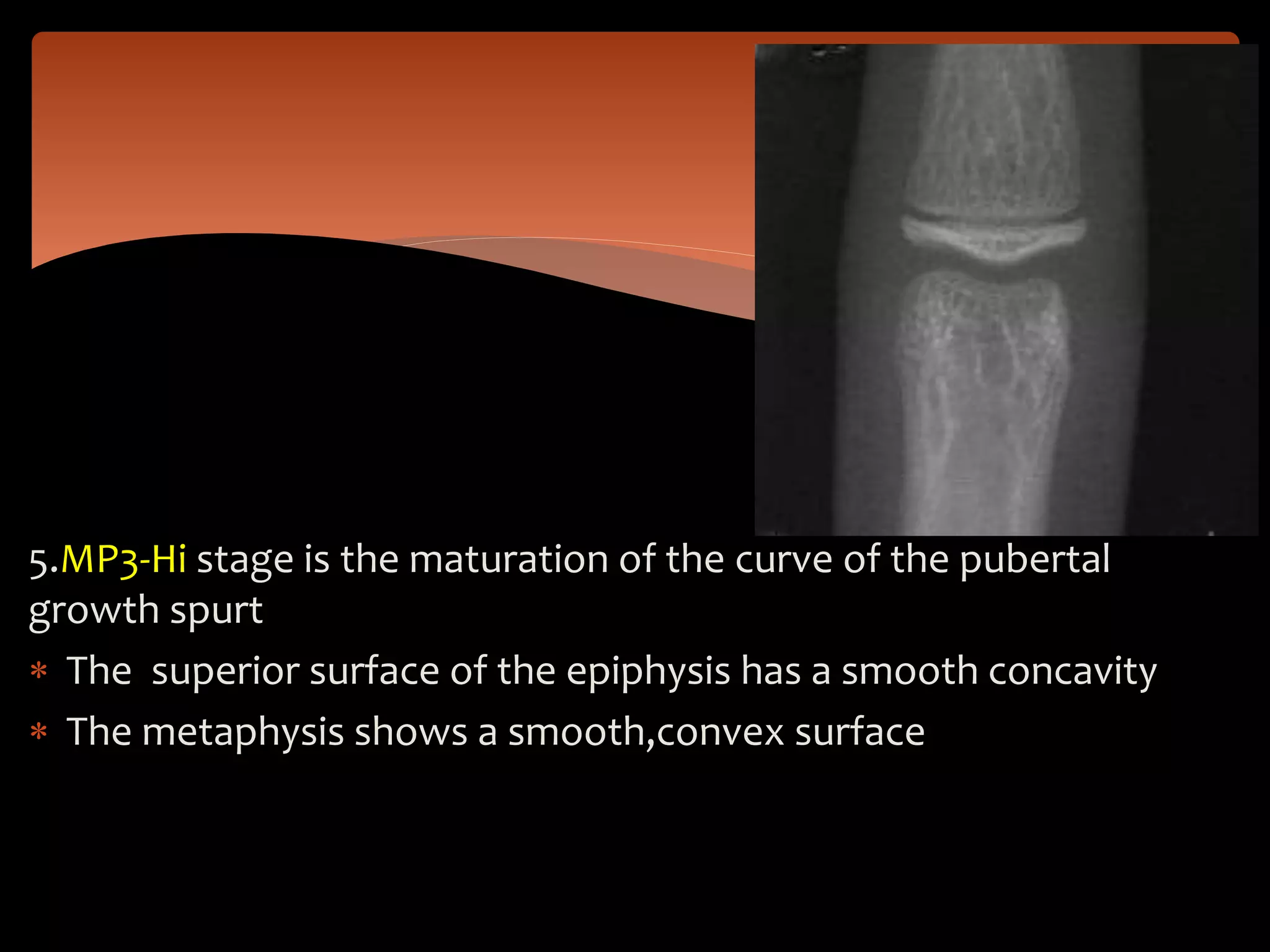 5.MP3-Hi stage is the maturation of the curve of the pubertal
growth spurt
 The superior surface of the epiphysis has a smooth concavity
 The metaphysis shows a smooth,convex surface
 