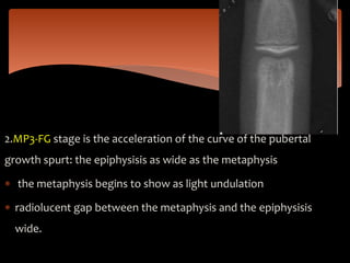 2.MP3-FG stage is the acceleration of the curve of the pubertal
growth spurt: the epiphysisis as wide as the metaphysis
 the metaphysis begins to show as light undulation
 radiolucent gap between the metaphysis and the epiphysisis
wide.
 