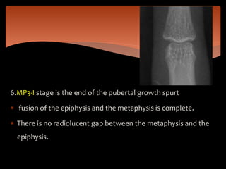 6.MP3-I stage is the end of the pubertal growth spurt
 fusion of the epiphysis and the metaphysis is complete.
 There is no radiolucent gap between the metaphysis and the
epiphysis.
 