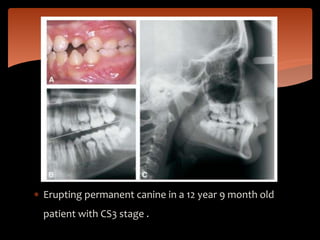  Erupting permanent canine in a 12 year 9 month old
patient with CS3 stage .
 