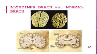 recent advances in the treatment of alzheimers disease.pptx