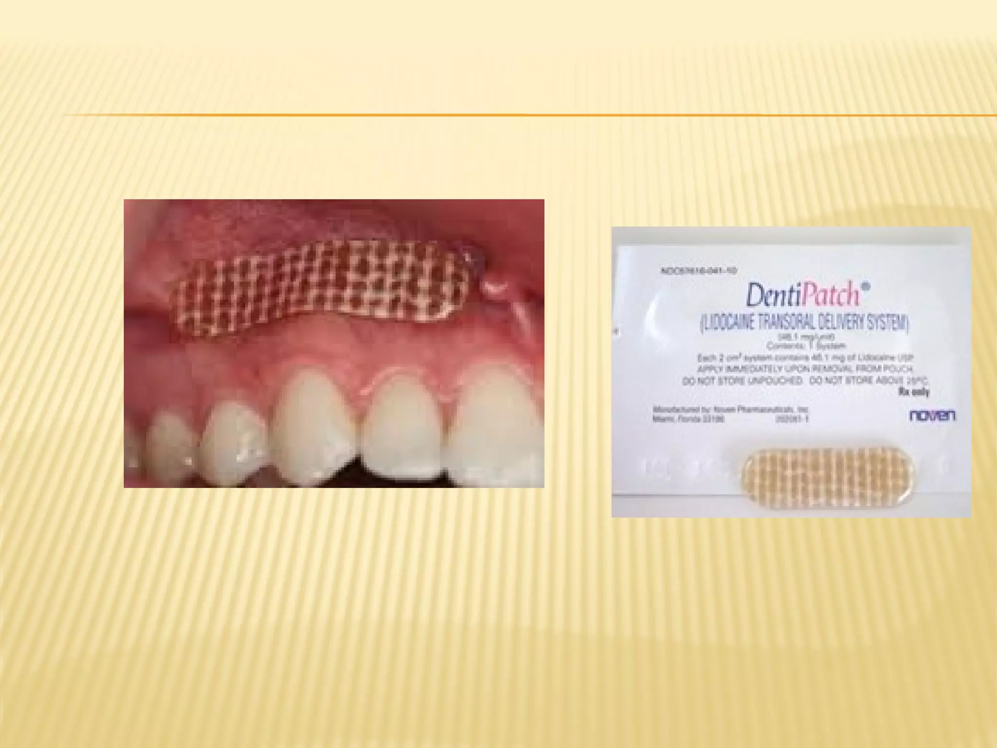 Recent Advances in local Anaesthesia in dentistry | PPT