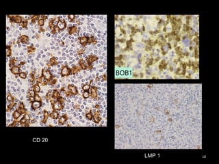 CD 20

        LMP 1   10
 