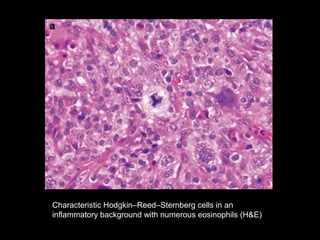 Characteristic Hodgkin–Reed–Sternberg cells in an
inflammatory background with numerous eosinophils (H&E)
 