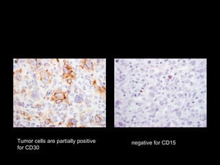 Tumor cells are partially positive   negative for CD15
for CD30
 