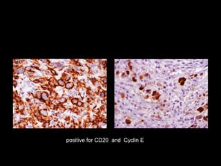 positive for CD20 and Cyclin E
 