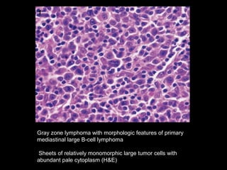 Gray zone lymphoma with morphologic features of primary
mediastinal large B-cell lymphoma

 Sheets of relatively monomorphic large tumor cells with
abundant pale cytoplasm (H&E)
 
