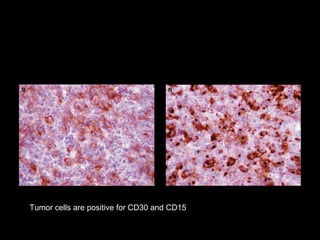Tumor cells are positive for CD30 and CD15
 