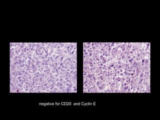 negative for CD20 (i) and Cyclin E (j)




negative for CD20 and Cyclin E
 