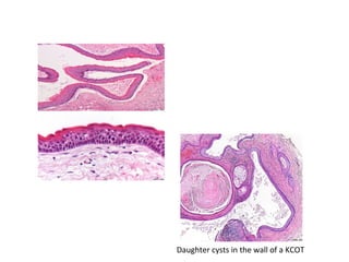Daughter cysts in the wall of a KCOT
 