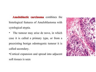 Ameloblastic carcinomaAmeloblastic carcinoma combines the
histological features of Ameloblastoma with
cytological atypia.
• The tumour may arise de novo, in which
case it is called a primary type, or from a
preexisting benign odontogenic tumour it is
called secondary.
•Cortical expansion and spread into adjacent
soft tissues is seen
 