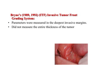 Bryne’s (1989, 1992) (ITF) Invasive Tumor FrontBryne’s (1989, 1992) (ITF) Invasive Tumor Front
Grading System:Grading System:
• Parameters were measured in the deepest invasive margins.
• Did not measure the entire thickness of the tumor
 