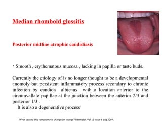 Median rhomboid glossitis
Posterior midline atrophic candidiasis
• Smooth , erythematous mucosa , lacking in papilla or taste buds.
Currently the etiology of is no longer thought to be a developmental
anomoly but persistent inflammatory process secondary to chronic
infection by candida albicans with a location anterior to the
circumvallate papillae at the junction between the anterior 2/3 and
posterior 1/3 .
It is also a degenerative process
What caused this symptomatic change on tounge? Dermatol. Vol 15-issue 8 aug 2007.
 