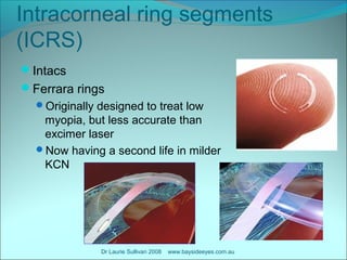Intacs Recent developments in corneal surgery | PPT