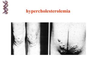 hypercholesterolemia
 
