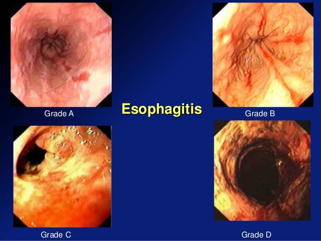 Recent management of gerd from consensus to clinical ...