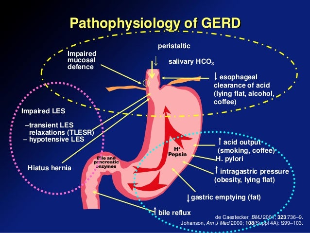 Recent management of gerd from consensus to clinical ...