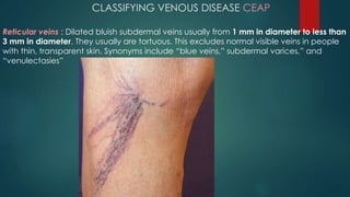 Recent management of primary varicose veins | PPTX