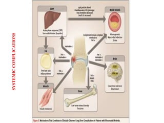 RECENT ADVANCES IN TREATMENT OF RHEUMATOID ARTHRITIS | PPTX