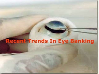 Recent Trends In Eye Banking
 