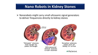  Nanorobots might carry small ultrasonic signal generators
to deliver frequencies directly to kidney stones
53
Nano Robots in Kidney Stones
 