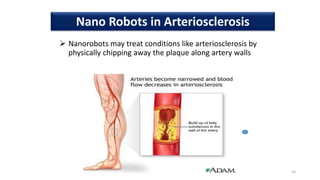  Nanorobots may treat conditions like arteriosclerosis by
physically chipping away the plaque along artery walls
54
Nano Robots in Arteriosclerosis
 