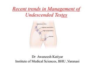 Recent trends in Management of
Undescended Testes
Dr Awaneesh Katiyar
Institute of Medical Sciences, BHU ,Varanasi
 