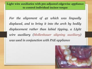 112
Light wire auxiliaries with pre-adjusted edgewise appliance
to control individual incisor torque
For the alignment of 42 which was lingually
displaced, and to bring it into the arch by bodily
displacement rather than labial tipping, a LIght
wire auxiliary (Mollenhauer aligning auxiliary)
was used in conjunction with PAE appliance
 