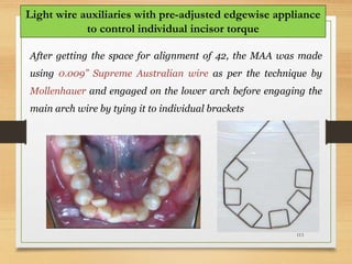 113
Light wire auxiliaries with pre-adjusted edgewise appliance
to control individual incisor torque
After getting the space for alignment of 42, the MAA was made
using 0.009” Supreme Australian wire as per the technique by
Mollenhauer and engaged on the lower arch before engaging the
main arch wire by tying it to individual brackets
 