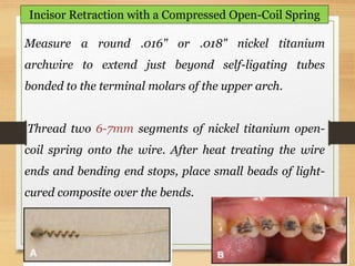 118
Incisor Retraction with a Compressed Open-Coil Spring
Measure a round .016" or .018" nickel titanium
archwire to extend just beyond self-ligating tubes
bonded to the terminal molars of the upper arch.
Thread two 6-7mm segments of nickel titanium open-
coil spring onto the wire. After heat treating the wire
ends and bending end stops, place small beads of light-
cured composite over the bends.
 