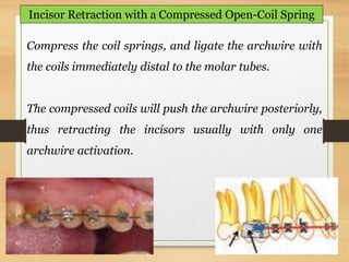119
Incisor Retraction with a Compressed Open-Coil Spring
Compress the coil springs, and ligate the archwire with
the coils immediately distal to the molar tubes.
The compressed coils will push the archwire posteriorly,
thus retracting the incisors usually with only one
archwire activation.
 