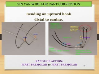 125
YIN YAN WIRE FOR CANT CORRECTION
Bending an upward hook
distal to canine.
RANGE OF ACTION:
FIRST PREMOLAR to FIRST PREMOLAR
 