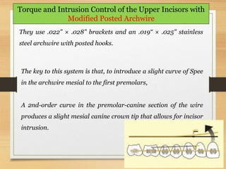 131
Torque and Intrusion Control of the Upper Incisors with
Modified Posted Archwire
They use .022" × .028" brackets and an .019“ × .025" stainless
steel archwire with posted hooks.
The key to this system is that, to introduce a slight curve of Spee
in the archwire mesial to the first premolars,
A 2nd-order curve in the premolar-canine section of the wire
produces a slight mesial canine crown tip that allows for incisor
intrusion.
 