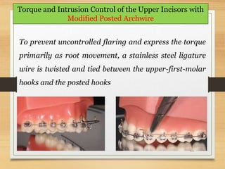 132
Torque and Intrusion Control of the Upper Incisors with
Modified Posted Archwire
To prevent uncontrolled flaring and express the torque
primarily as root movement, a stainless steel ligature
wire is twisted and tied between the upper-first-molar
hooks and the posted hooks
 
