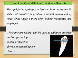136
Uses of the Vertical Slot in Orthodontic Brackets
The uprighting springs are inserted into the canine V-
slots and oriented to produce a mesial component of
force while Class I intra-arch sliding mechanics are
employed.
The same procedure can be used to enhance anterior
anchorage during
molar protraction
for asymmetrical space
closure.7
 