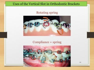 138
Uses of the Vertical Slot in Orthodontic Brackets
Rotating spring
Compliance + spring
 
