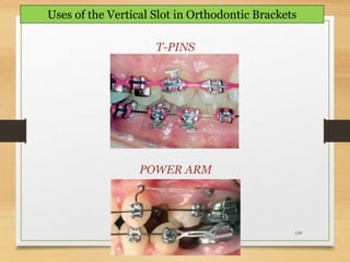 139
Uses of the Vertical Slot in Orthodontic Brackets
T-PINS
POWER ARM
 
