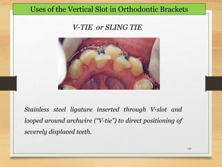 140
Uses of the Vertical Slot in Orthodontic Brackets
Stainless steel ligature inserted through V-slot and
looped around archwire (“V-tie”) to direct positioning of
severely displaced teeth.
V-TIE or SLING TIE
 