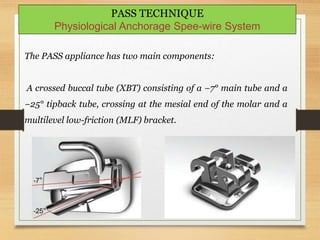 143
PASS TECHNIQUE
Physiological Anchorage Spee-wire System
The PASS appliance has two main components:
A crossed buccal tube (XBT) consisting of a −7° main tube and a
−25° tipback tube, crossing at the mesial end of the molar and a
multilevel low-friction (MLF) bracket.
 
