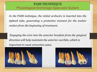 144
In the PASS technique, the initial archwire is inserted into the
tipback tube, generating a protective moment for the anchor
molars from the beginning of treatment.
Engaging the wire into the anterior brackets from the gingival
direction will help maintain the anterior overbite, which is
important in most extraction cases.
PASS TECHNIQUE
Physiological Anchorage Spee-wire System
 