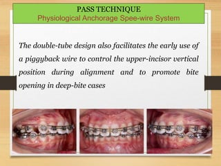 145
PASS TECHNIQUE
Physiological Anchorage Spee-wire System
The double-tube design also facilitates the early use of
a piggyback wire to control the upper-incisor vertical
position during alignment and to promote bite
opening in deep-bite cases
 