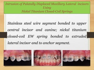 148
Intrusion of Palatally Displaced Maxillary Lateral incisors
Using
Nickel Titanium Closed-Coil Springs
Stainless steel wire segment bonded to upper
central incisor and canine; nickel titanium
closed-coil EW spring bonded to extruded
lateral incisor and to anchor segment.
 