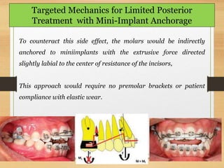 152
Targeted Mechanics for Limited Posterior
Treatment with Mini-Implant Anchorage
To counteract this side effect, the molars would be indirectly
anchored to miniimplants with the extrusive force directed
slightly labial to the center of resistance of the incisors,
This approach would require no premolar brackets or patient
compliance with elastic wear.
 