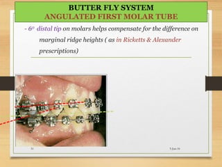 - 60 distal tip on molars helps compensate for the difference on
marginal ridge heights ( as in Ricketts & Alexander
prescriptions)
5-Jun-1651
BUTTER FLY SYSTEM
ANGULATED FIRST MOLAR TUBE
 