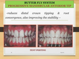 -reduces distal crown tipping & root
convergence, also improving the stability –
5-Jun-1652
BUTTER FLY SYSTEM
PROGRESSIVE MANDIBULAR ANTERIOR TIP
TENT POSTING
 