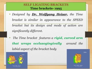 • Designed by Dr. Wolfgang Heiser, the Time
bracket is similar in appearance to the SPEED
bracket but its design and mode of action are
significantly different.
• The Time bracket features a rigid, curved arm
that wraps occlusogingivally around the
labial aspect of the bracket body
93
SELF LIGATING BRACKETS
Time brackets- 1995
 