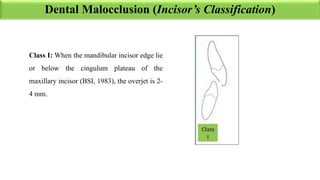 Recent Trends in the classification of Malocclusion.pdf