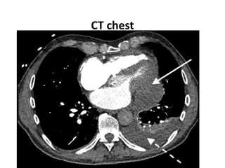 CT chest
 