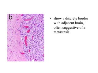 • show a discrete border
with adjacent brain,
often suggestive of a
metastasis
 