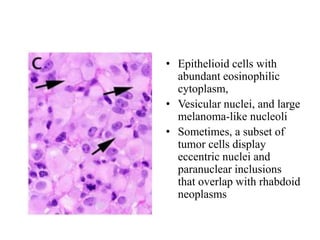 • Epithelioid cells with
abundant eosinophilic
cytoplasm,
• Vesicular nuclei, and large
melanoma-like nucleoli
• Sometimes, a subset of
tumor cells display
eccentric nuclei and
paranuclear inclusions
that overlap with rhabdoid
neoplasms
 